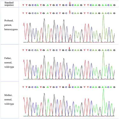 Case Report: Identification of Polygenic Mutations by Exome Sequencing